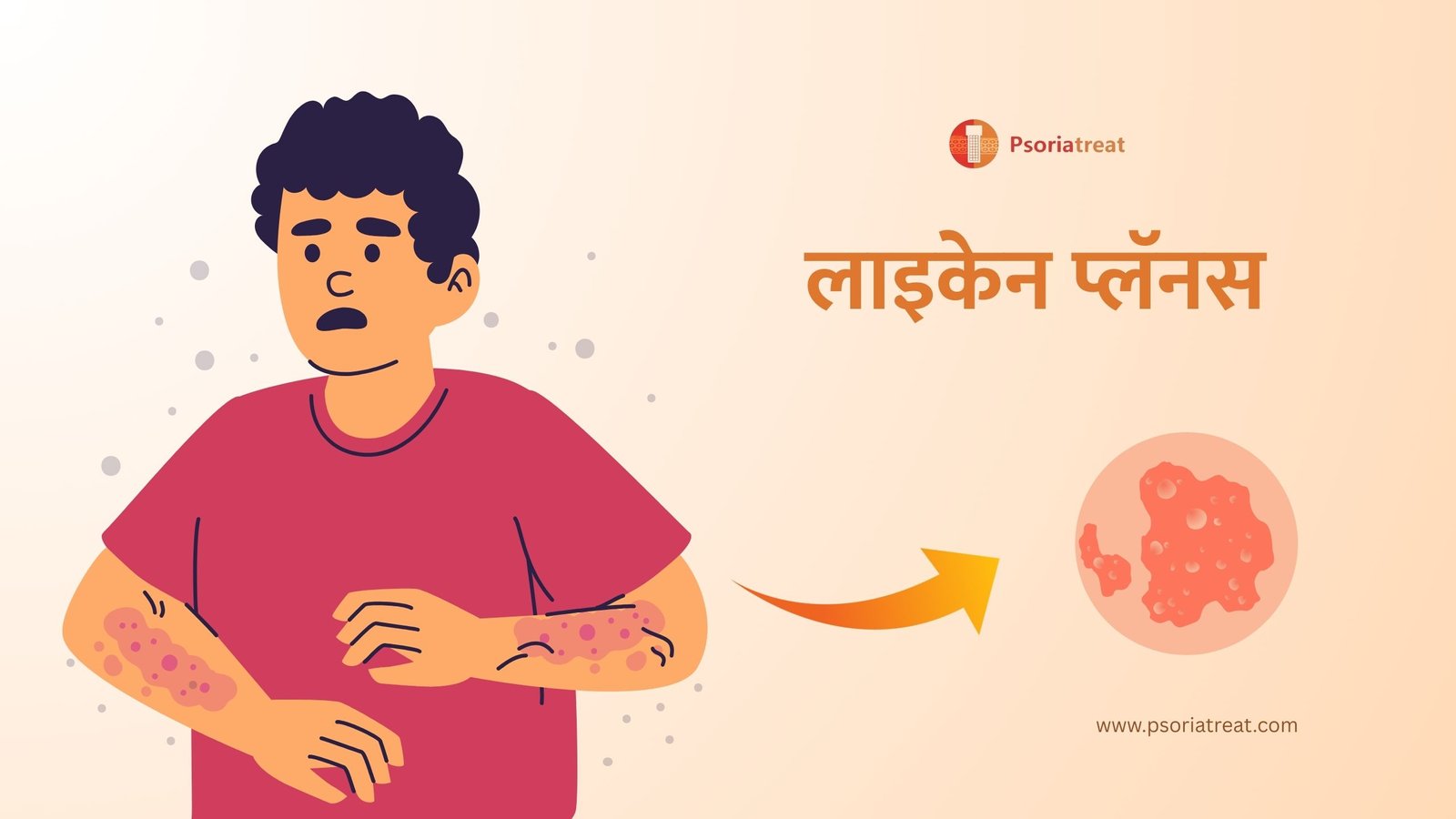 लाइकेन प्लॅनस