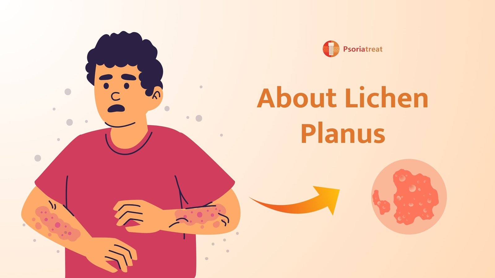 About Lichen Planus